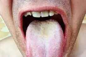 Can thrush be treated
