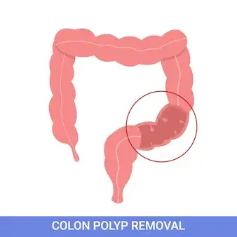Colorectal Polyps