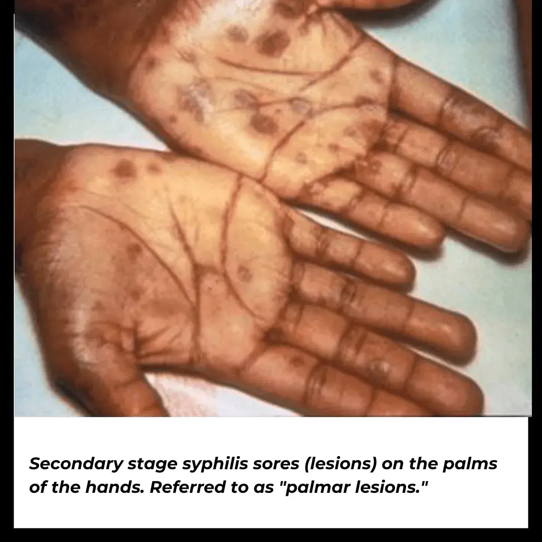 Secondary stage syphilis sores (lesions) on the palms of the hands. Referred to as palmar lesions.