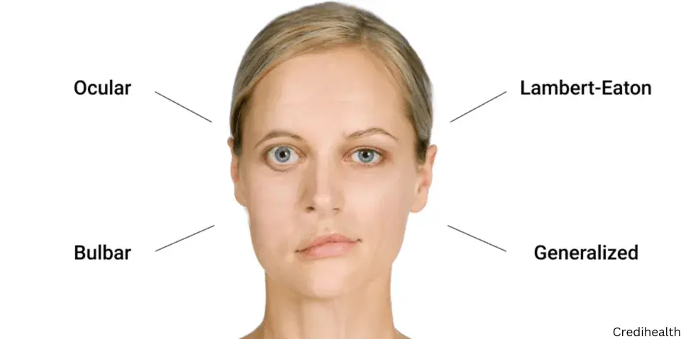 symptoms of Myasthenia Gravis