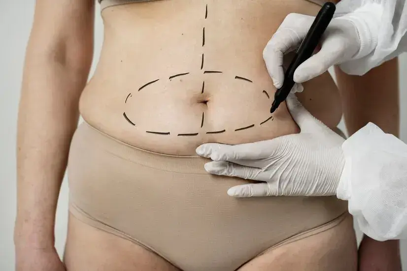 When Should I Consider Liposuction