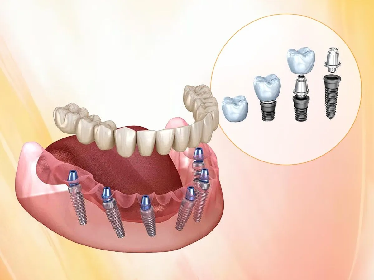 Dental Implants for Missing Teeth: Everyt...