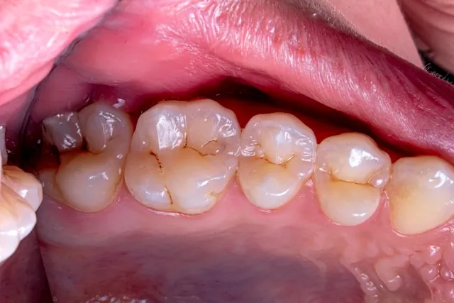 The Stages of Gum Disease and How to Trea...