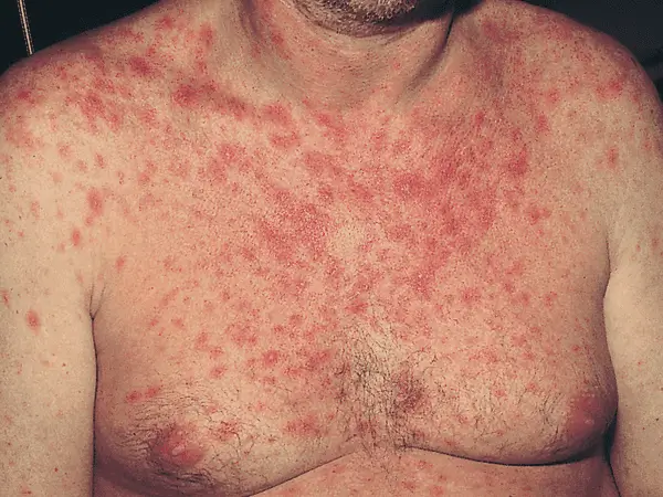HIV Symptoms in Hindi