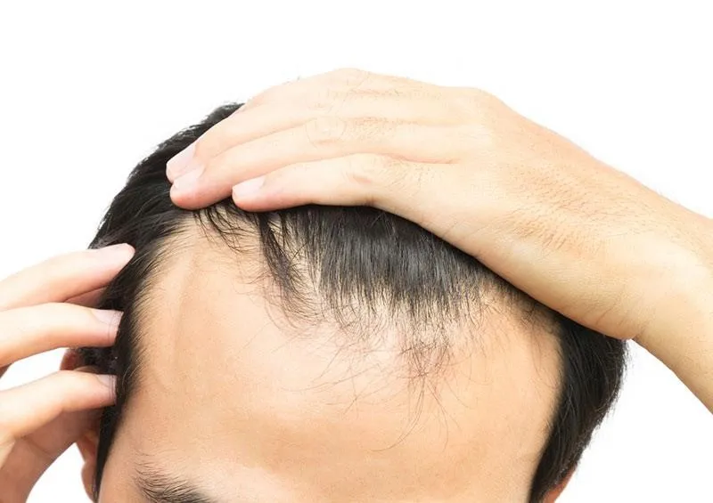 Hair Transplantation - Types and Treatment