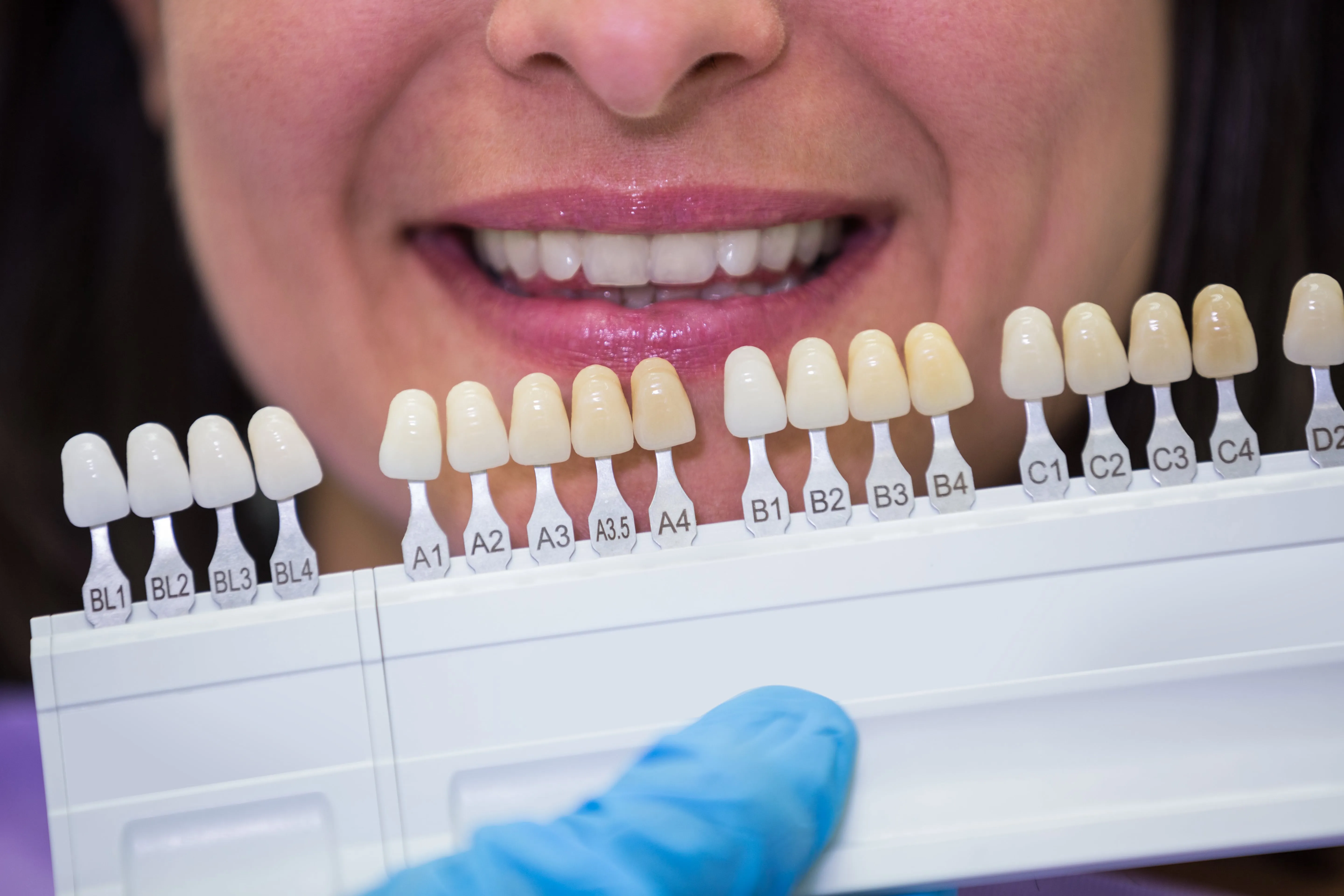 The 4 Types of Dental Crowns: Which One Is Right for You?