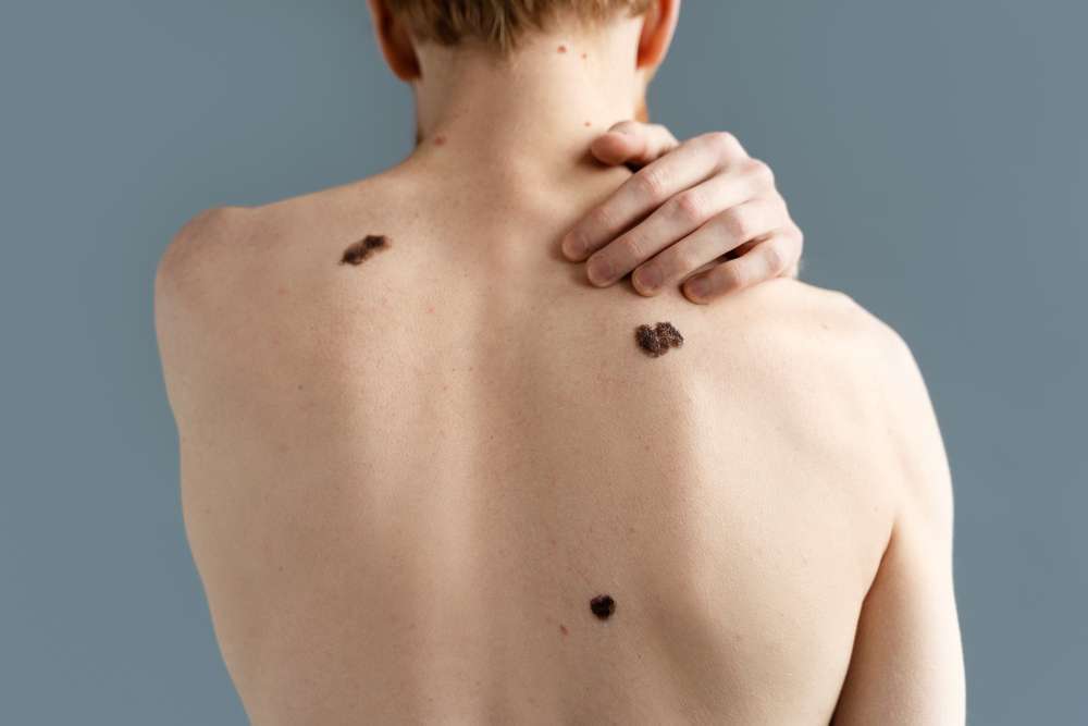 Warts Meaning in Hindi