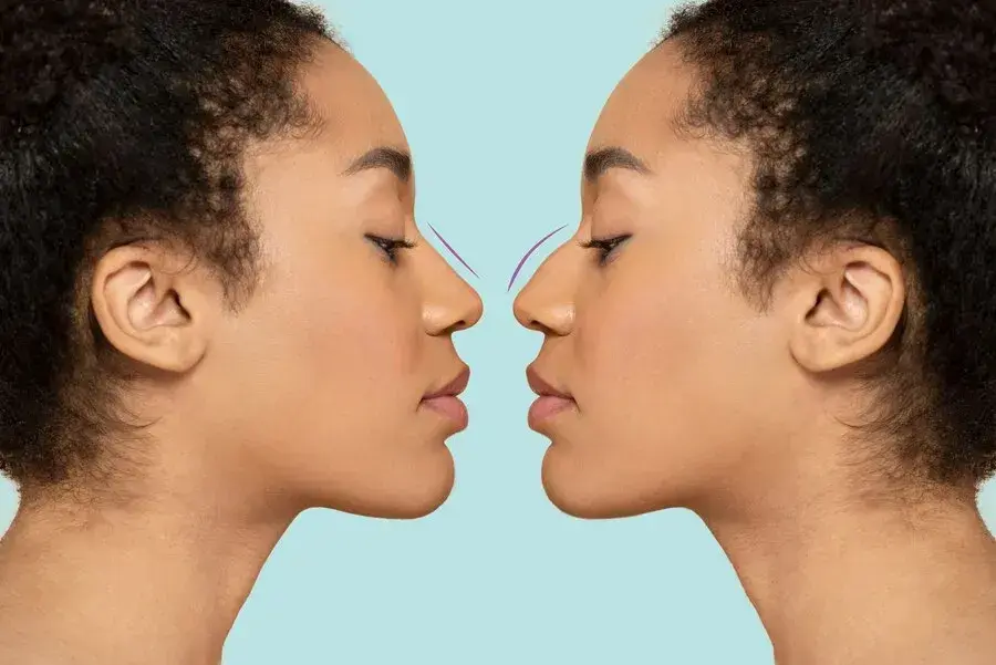 Ethnic Rhinoplasty Techniques