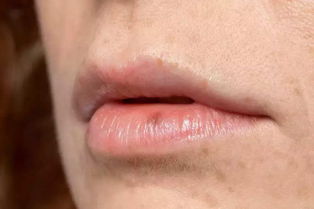 What Kills Cold Sores Instantly?
