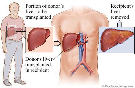 Pre-requisites for liver transplant donors