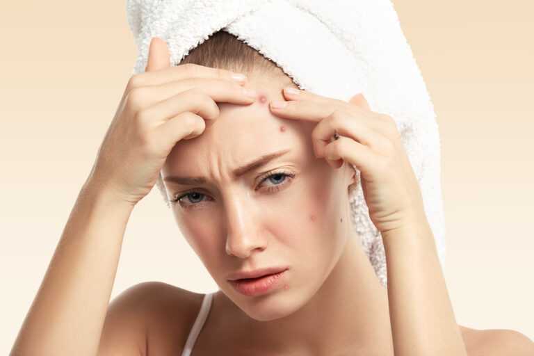 8 Best Pimple Removal Cream for Women of 2023