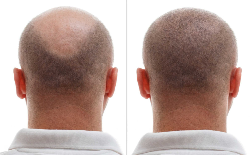 Best Hair Transplant in the World - Smile Hair Clinic