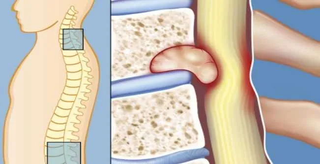 16 Different Types of Spinal Tumors and How to Spot Them