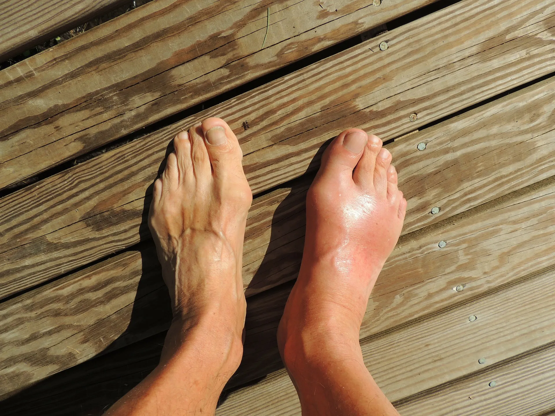 Gout: Causes, Symptoms and Treatment