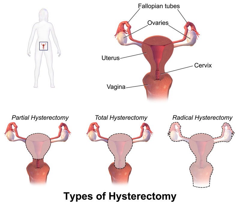 Types of Lavh Surgery