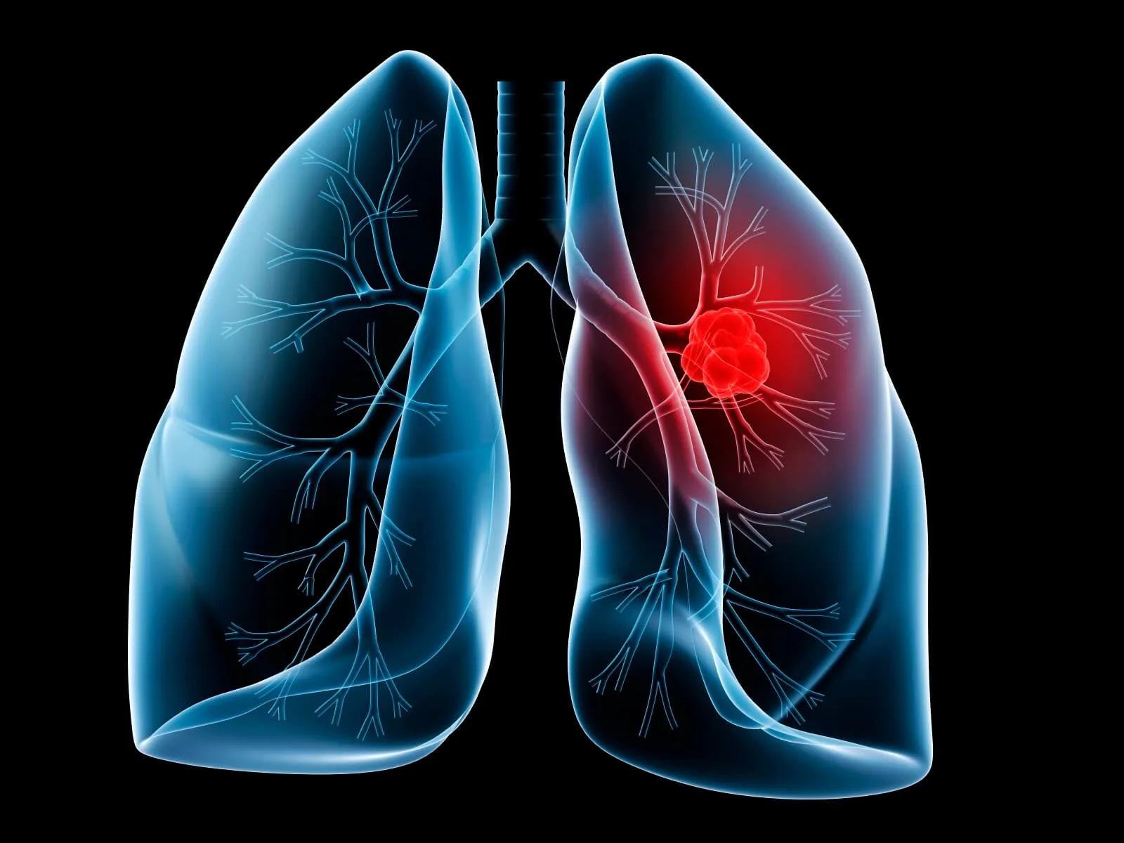 Things A Lung Cancer Patient Must Know