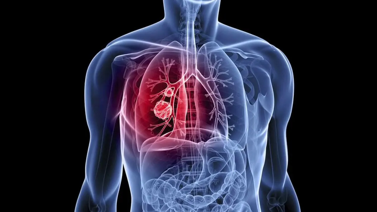 Lung Transplant: Things to Keep in Mind