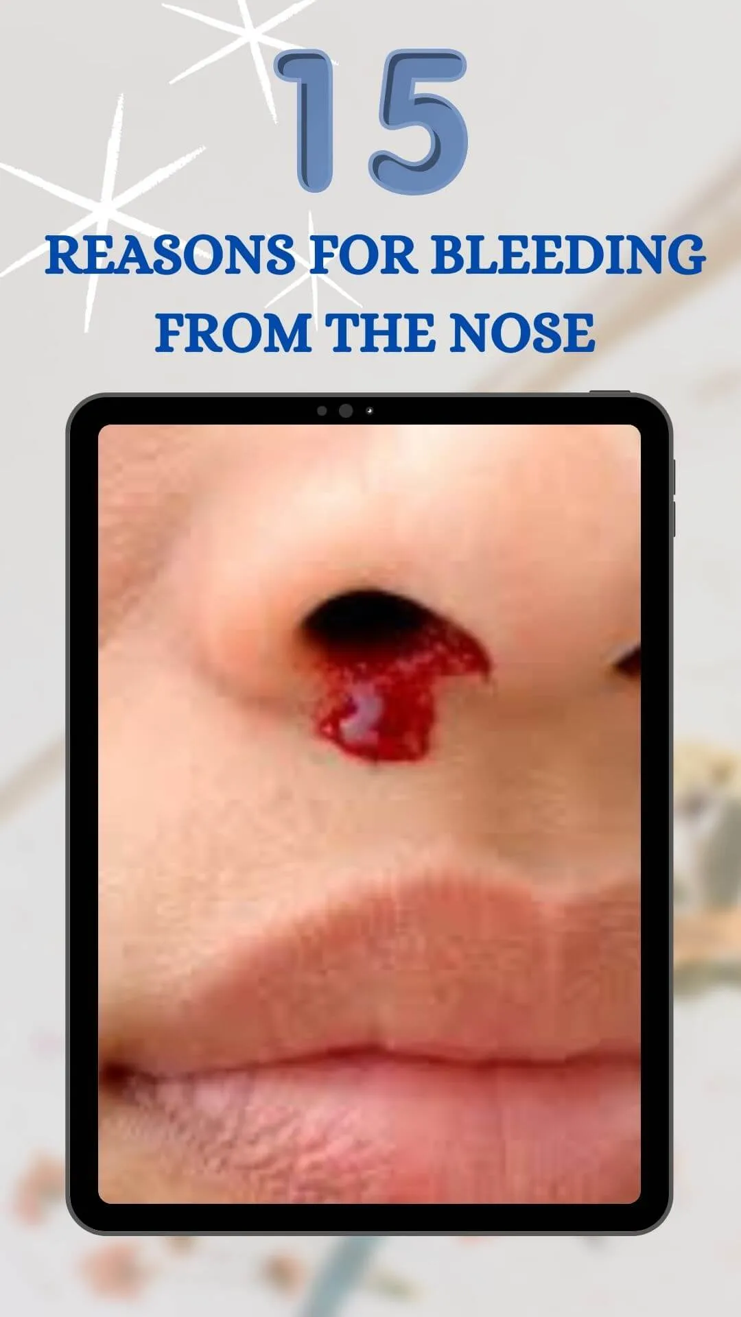 15 Reasons for Bleeding From The Nose