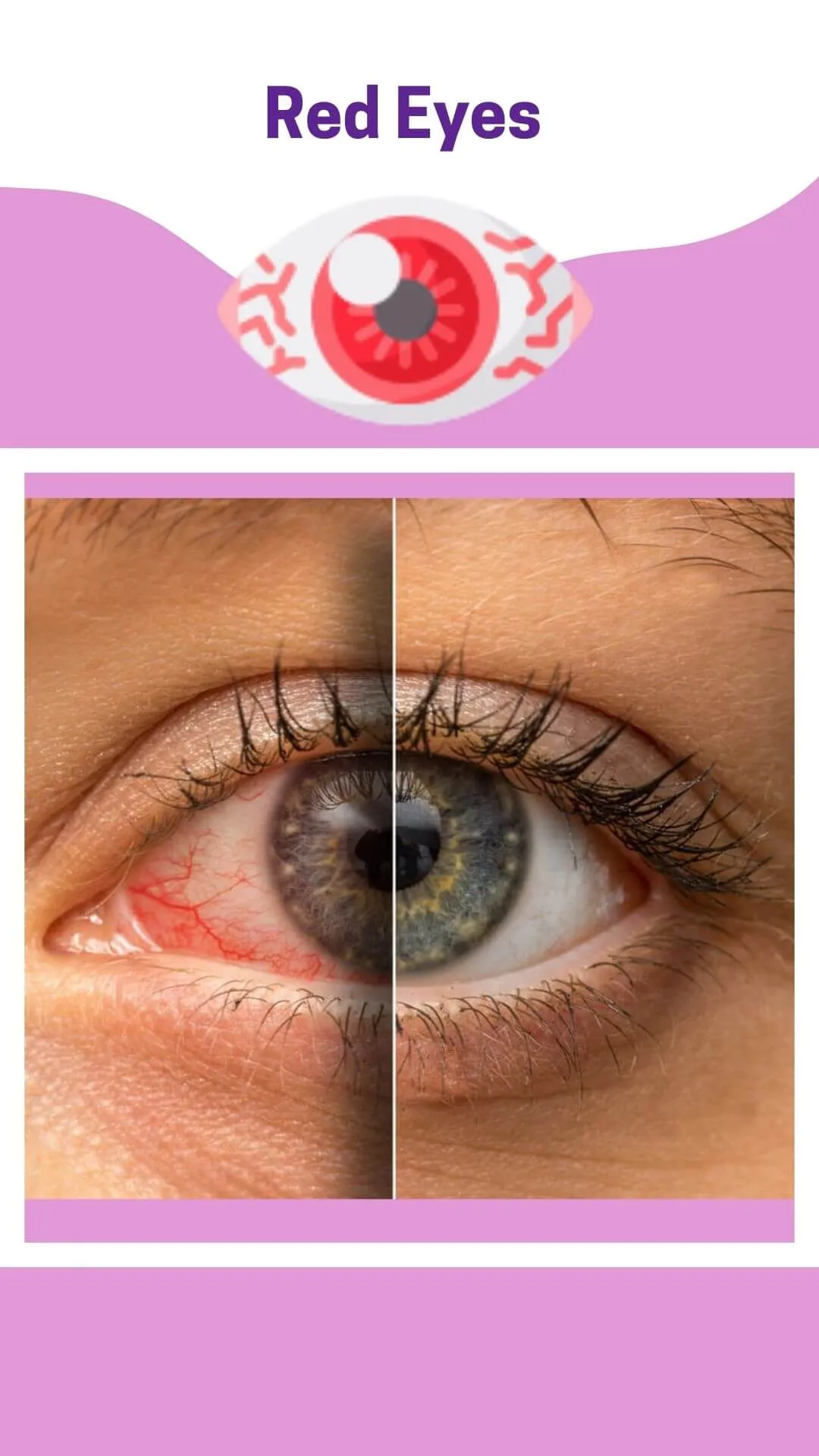 Do you know About The Serious Causes of Red Eyes?