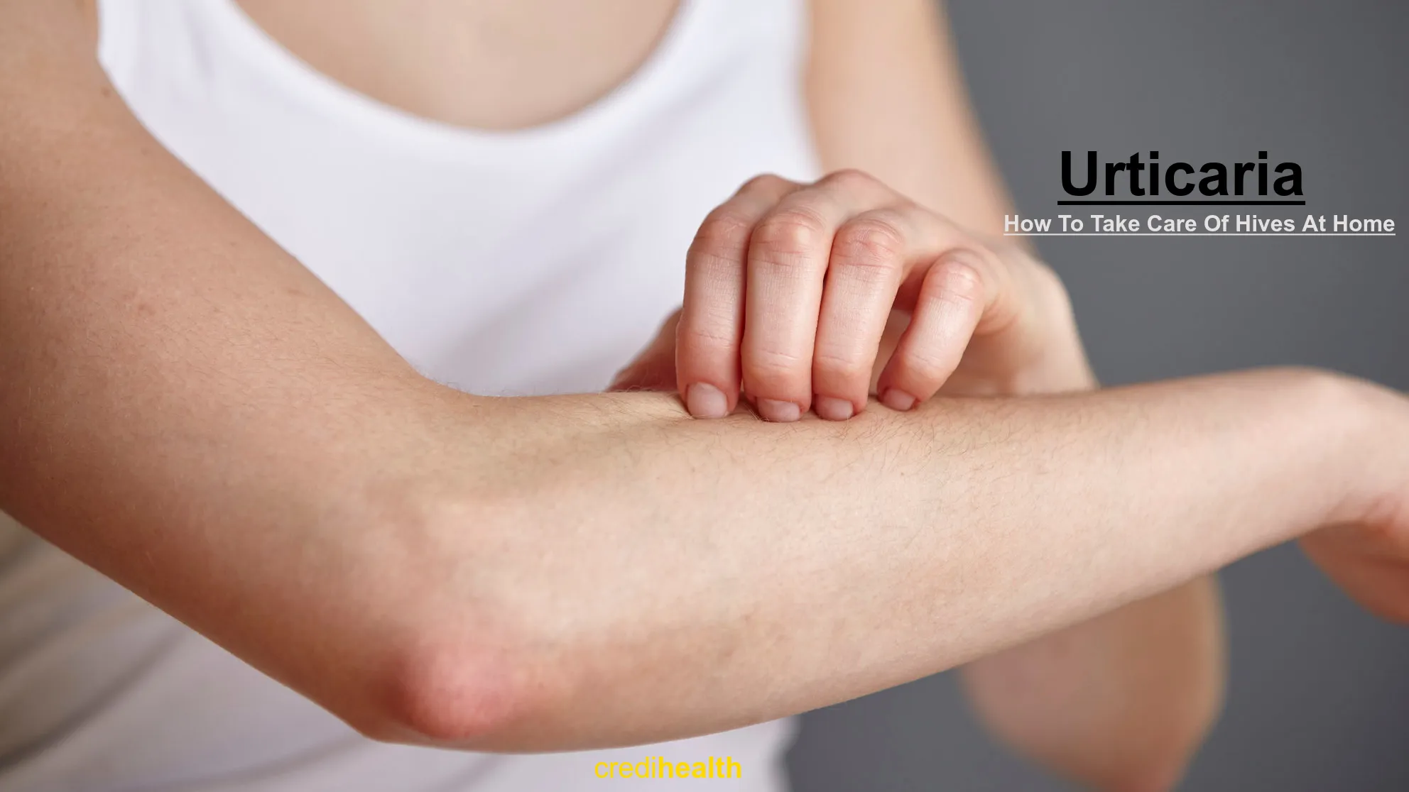15 Urticaria Home Remedies: How To Take Care Of Hives At Home