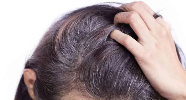 Difference Between Psoriasis and Dandruff | Man Matters