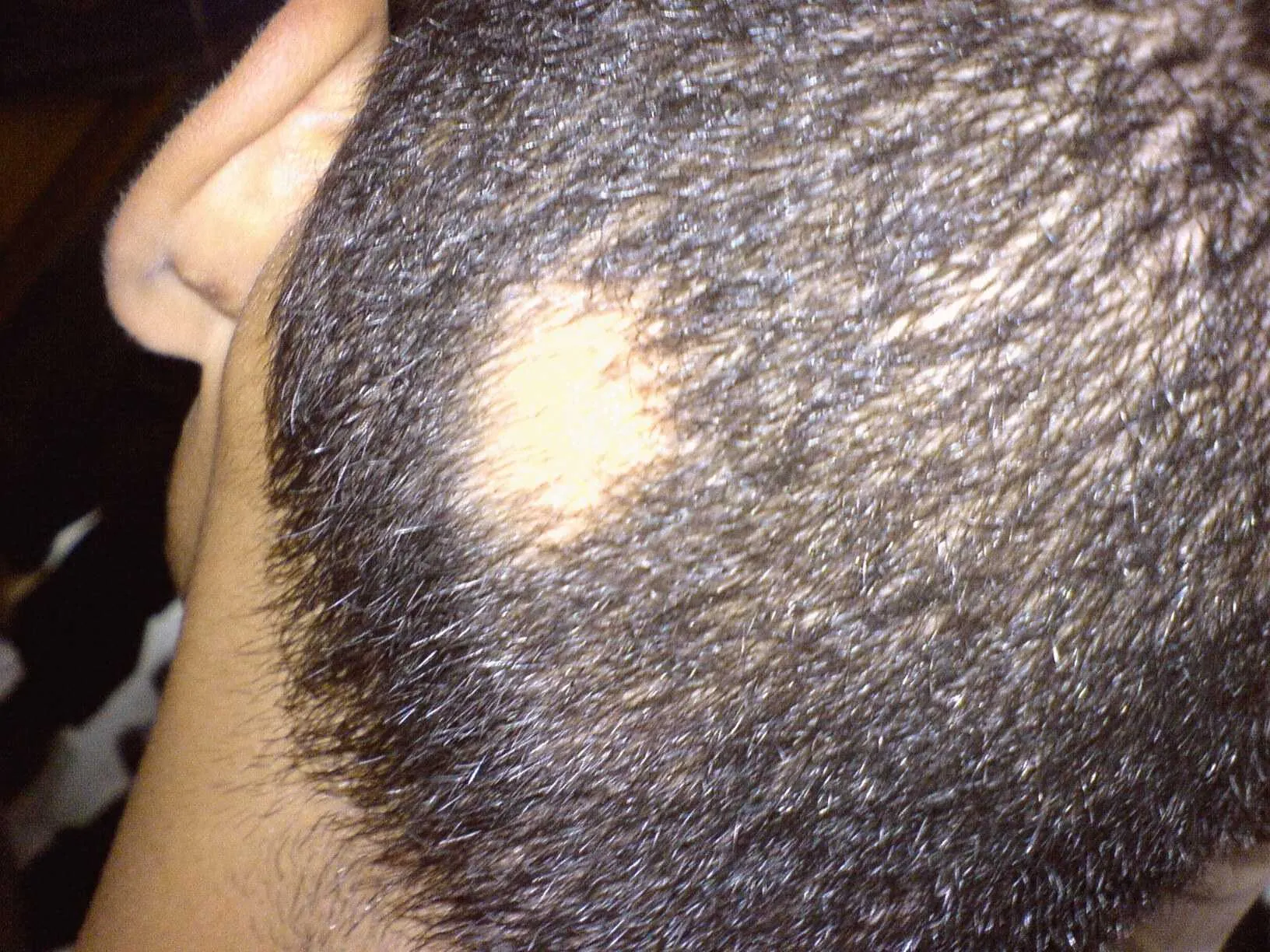 How to Stop Alopecia Areata from Spreading?
