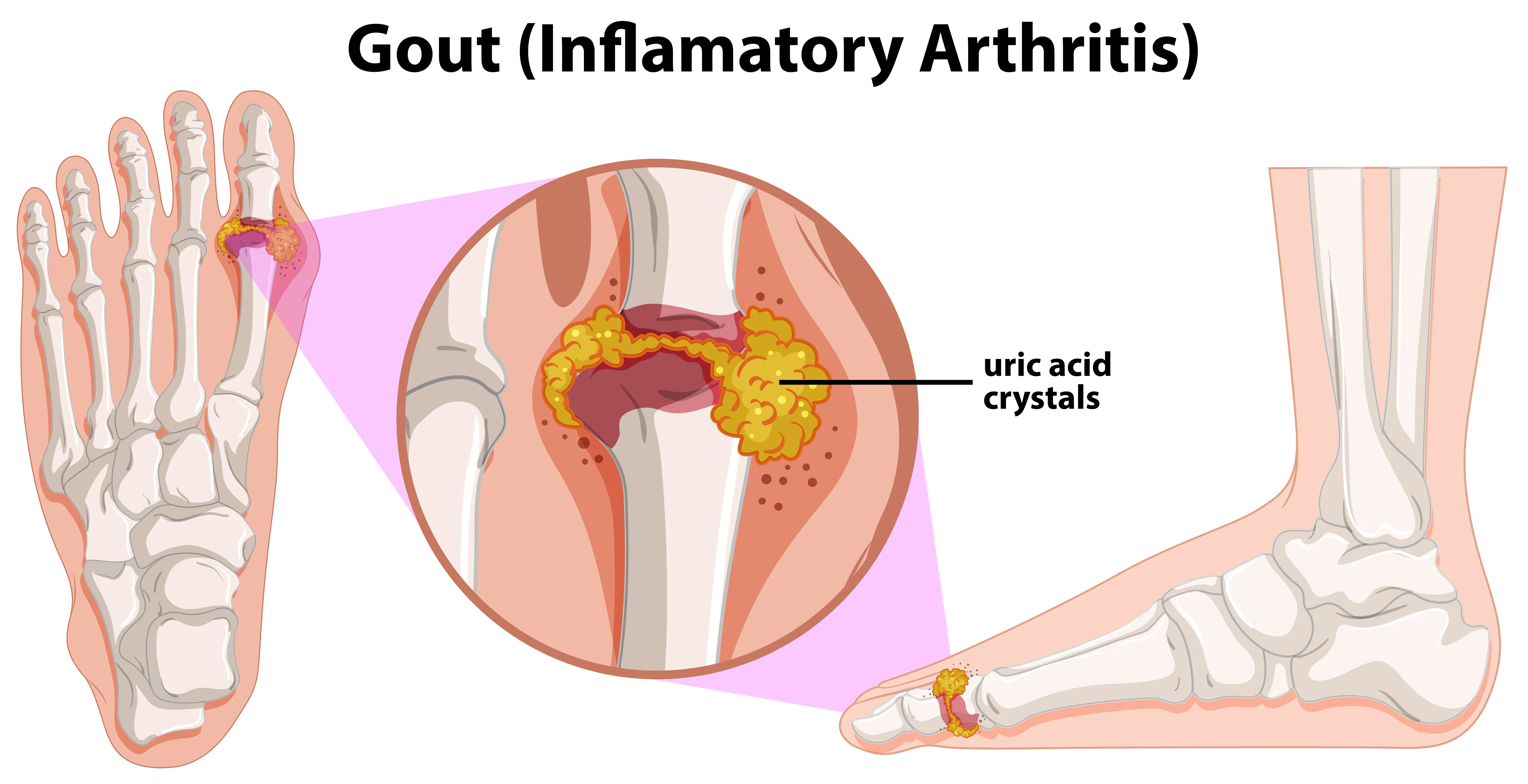 How to Cure High Uric Acid Permanently or Gout Naturally?