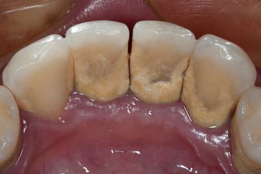 Dental Plaque - Gingivitis Early Stage 