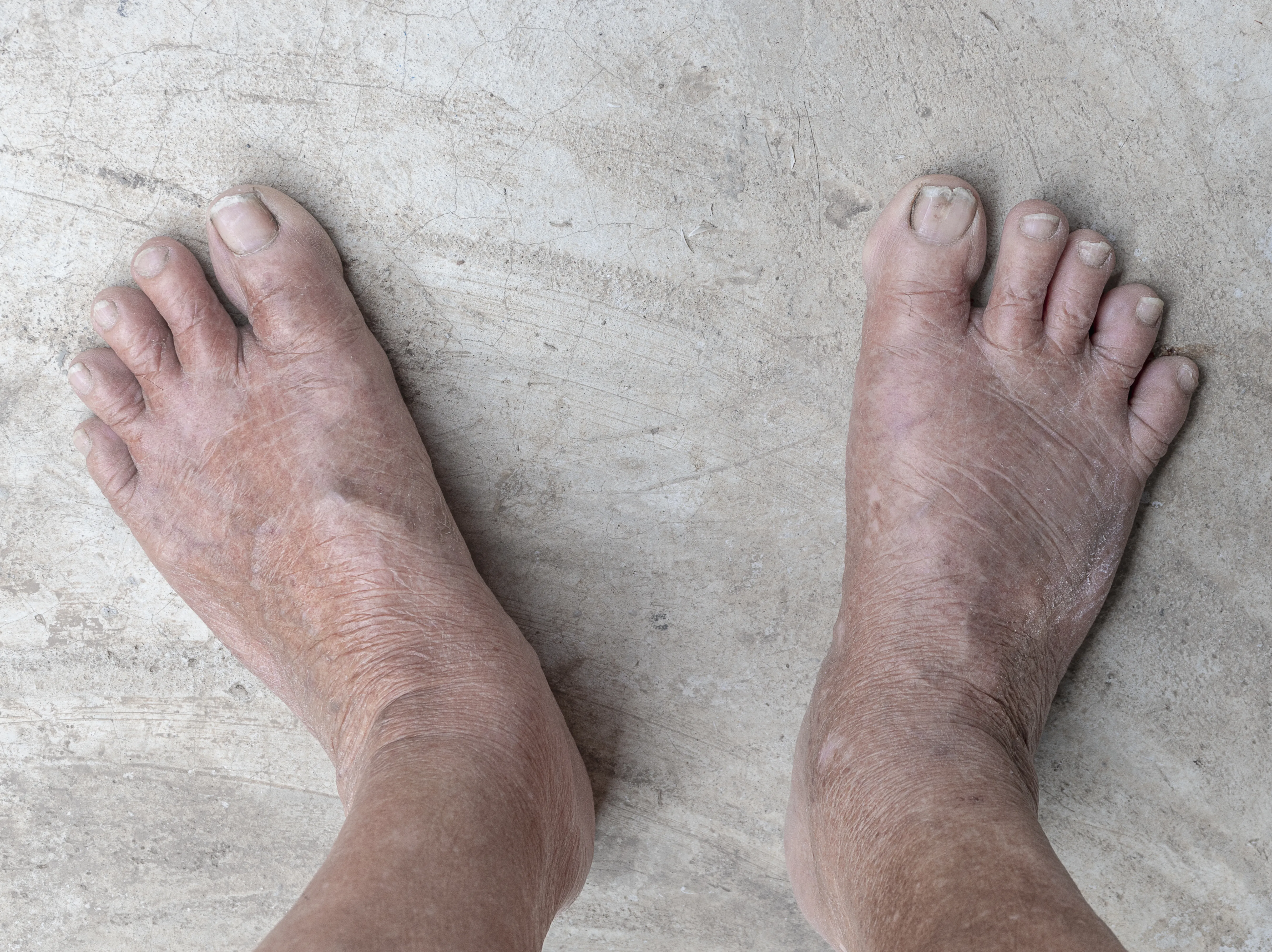 Diabetes Swollen Feet: Causes And Treatments