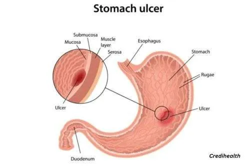 What You Need to Know About Treating Stomach Ulcers?
