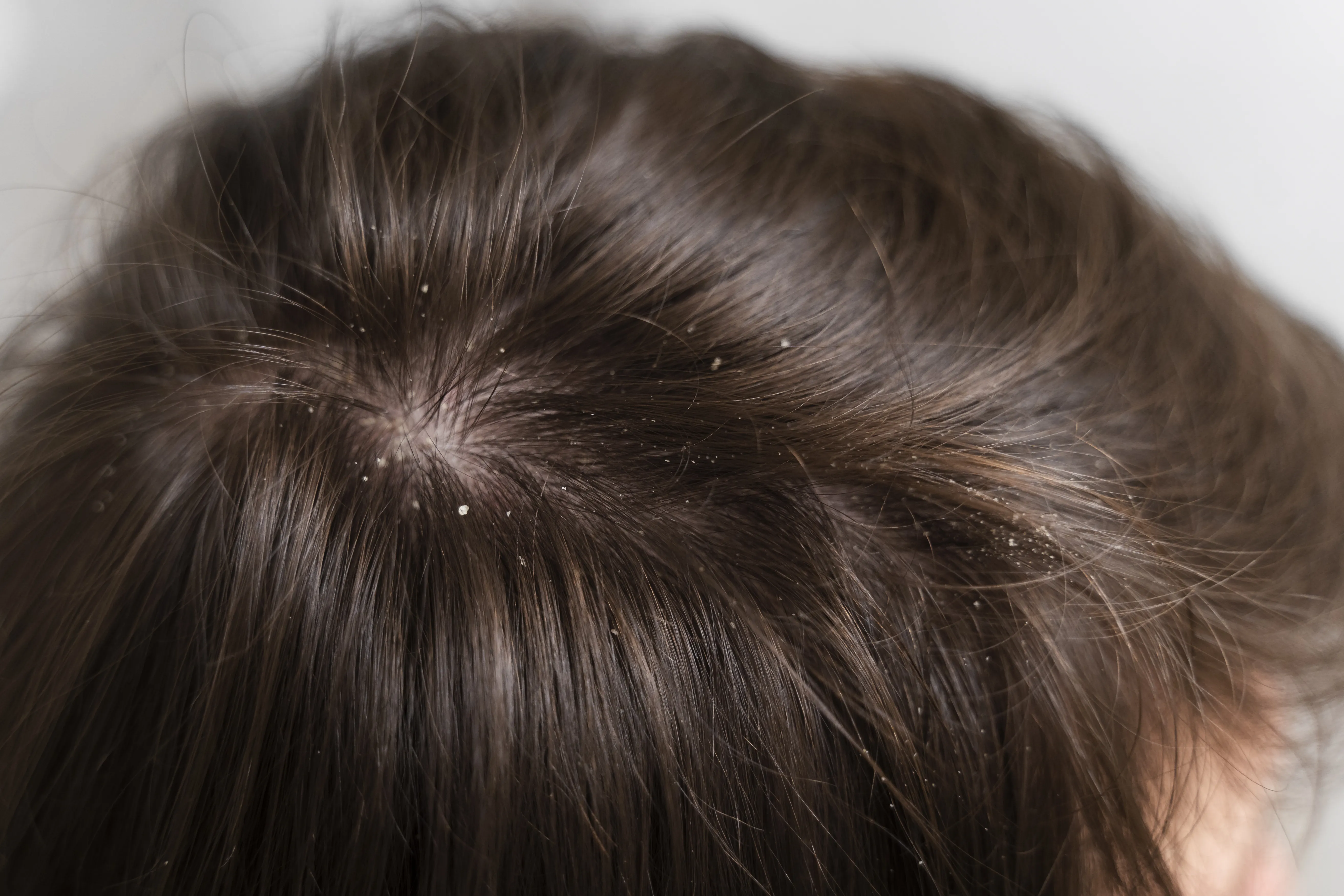 The Truth About Scalp Seborrheic Dermatitis And Hair Loss