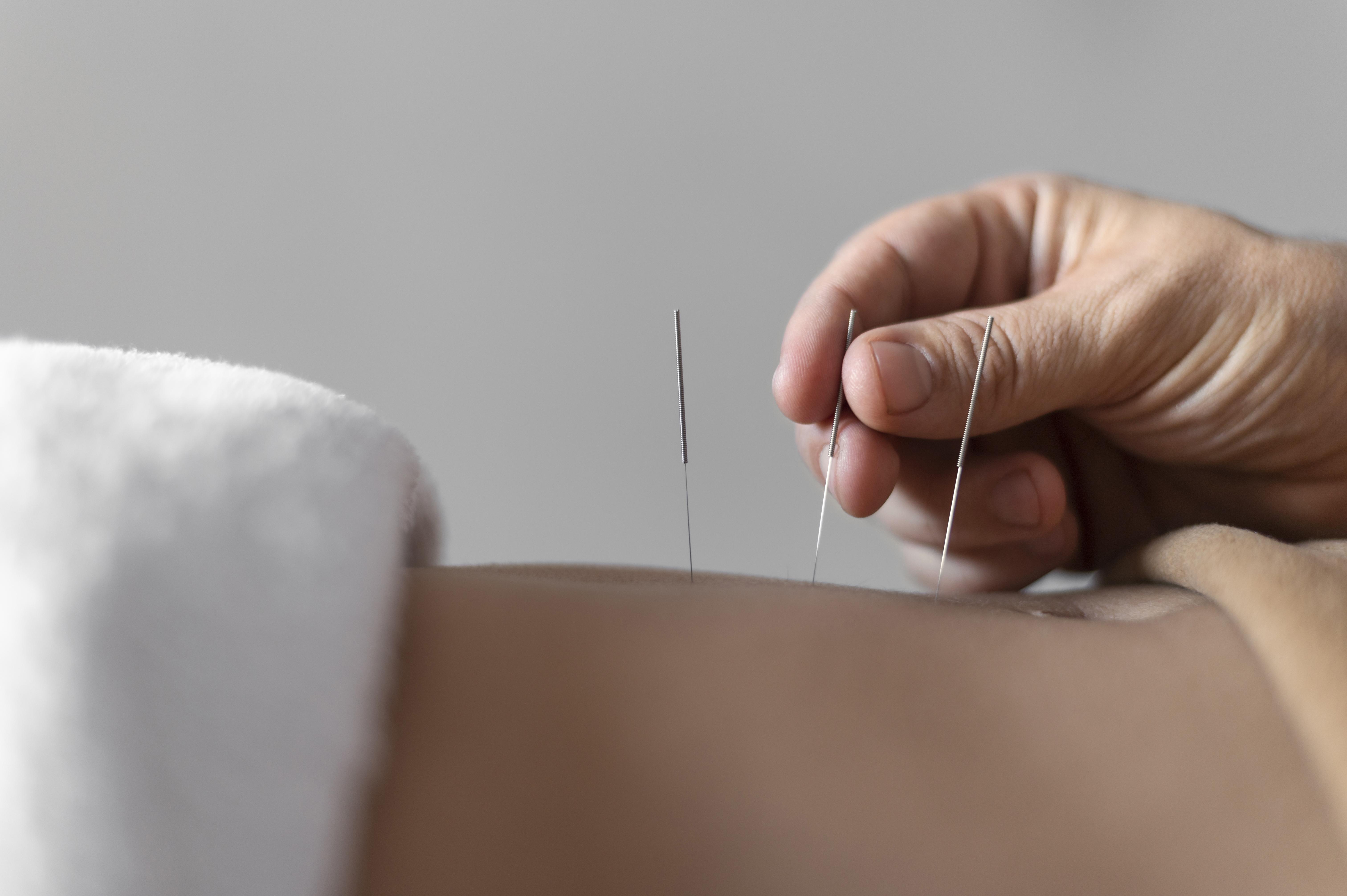 Acupuncture - urticaria home remedies