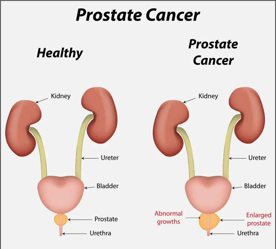 Early Sign Of Prostate Cancer What To Look Out For Credihealth