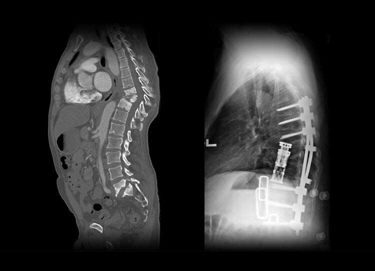 thoracic spine surgery