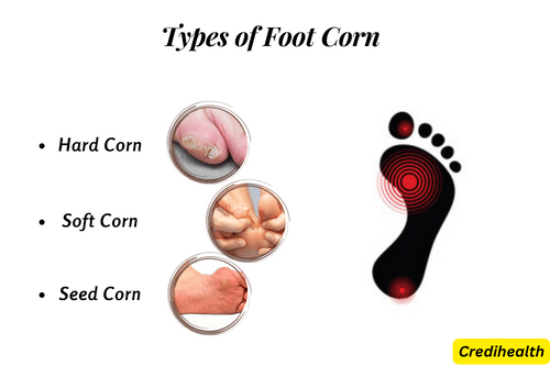 Types of Foot Corn - Seed Corn on Feet