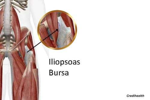 Bursitis iliopsoas