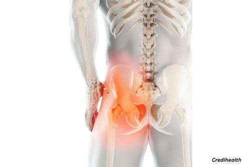 Bursitis of the Hip (Back)