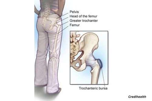 Bursitis of the hip (Side)