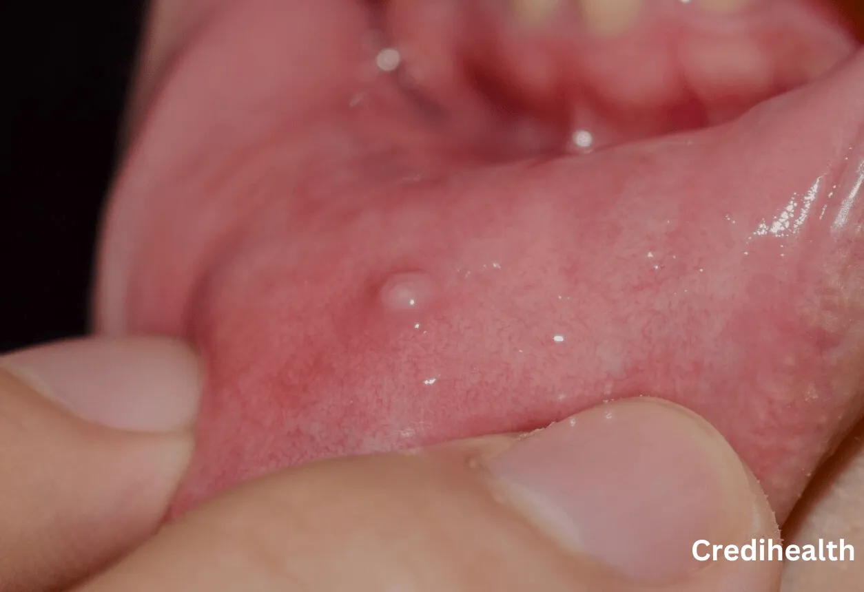 How to Prevent and Treat Mucous Cysts?