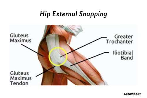 Hip external snapping