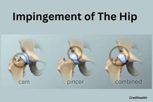 Impingement of the hip