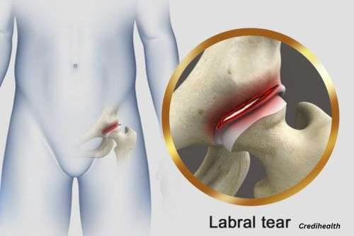 Labral tear in the hip