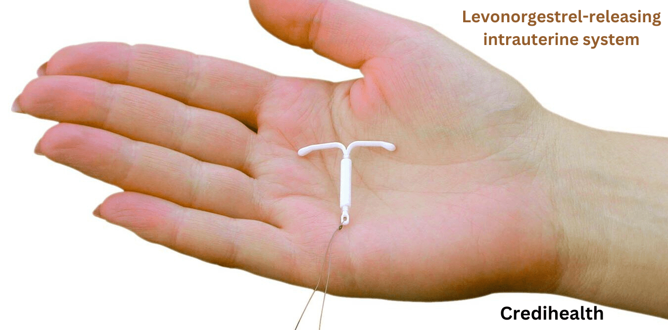 Levonorgestrel-releasing intrauterine system