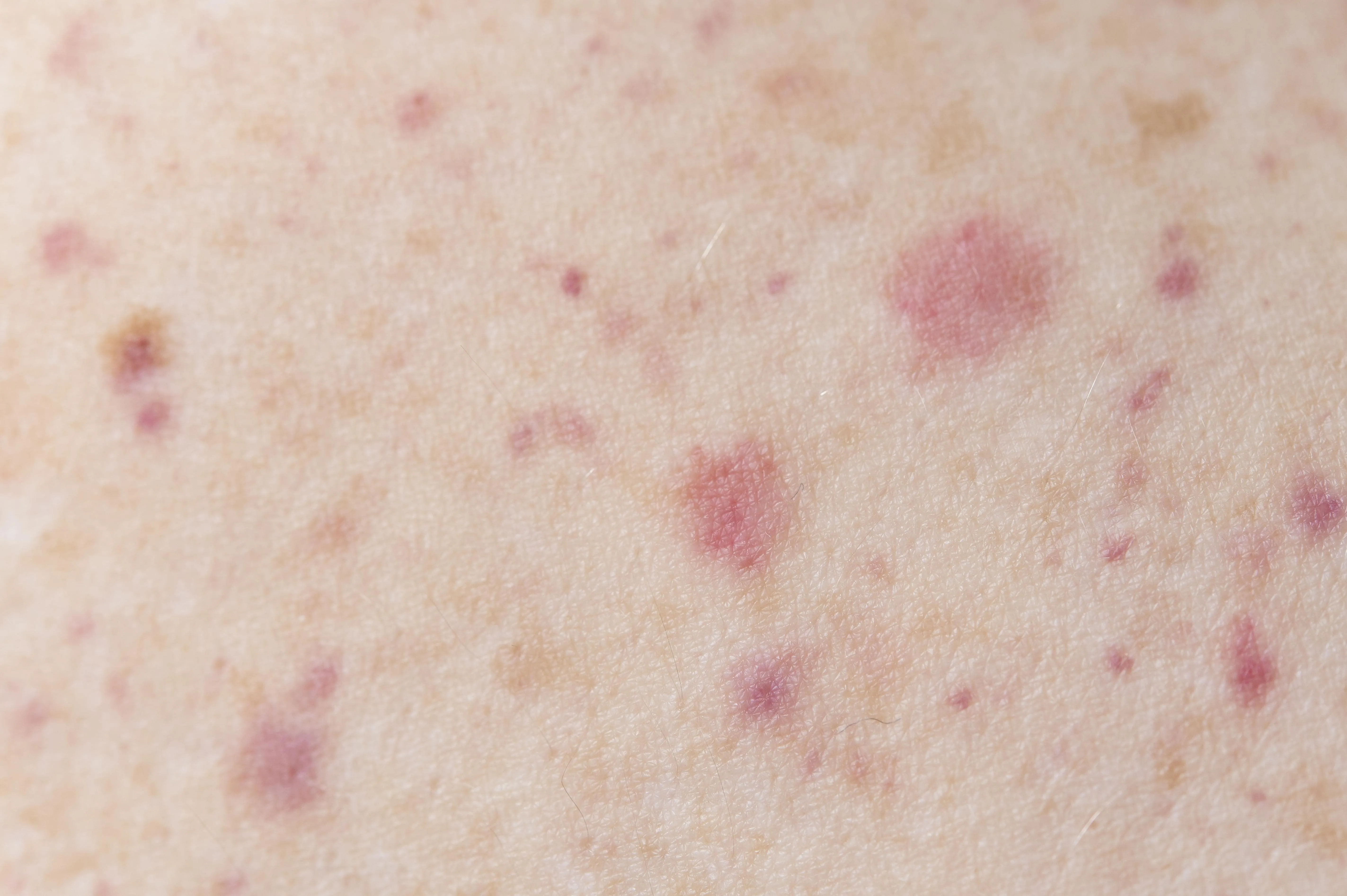 Skin Fungus: Causes, Symptoms, Treatments and Preventions.