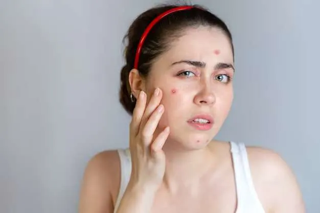 how-to-shrink-a-cystic-pimple-overnight