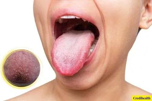 How To Get Rid of Bumps on The Back of The Tongue