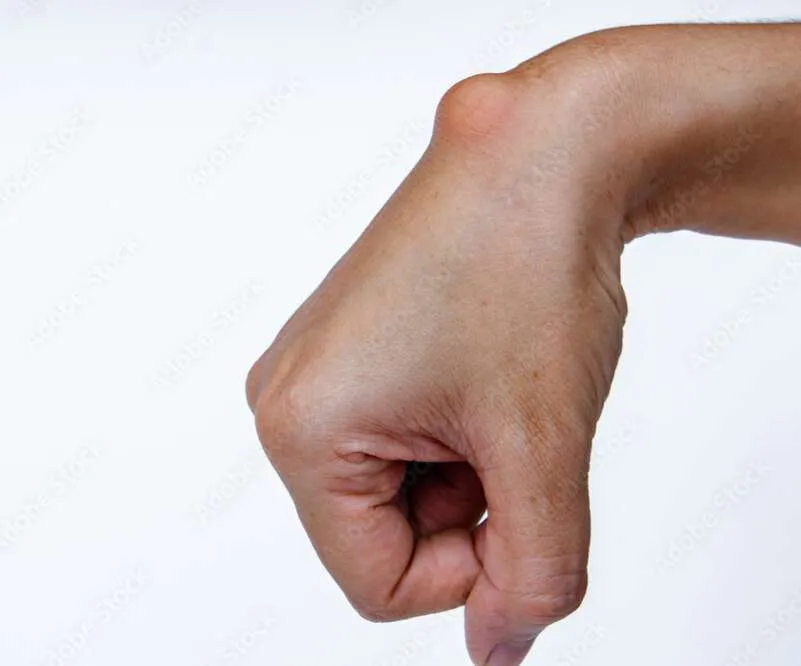 How to Drain a Ganglion Cyst Yourself?