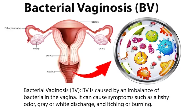 how to cure BV in one day