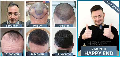 Hair Transplant